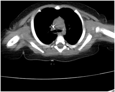 Assistance of next-generation sequencing for diagnosis of disseminated Bacillus Calmette-Guerin disease with X-SCID in an infant: a case report and literature review